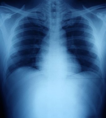 Bir insan Toraks (göğüs Xray).