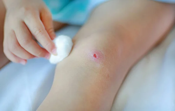 Herida de cerca en rodilla de niño. Madre que viste la rodilla del niño . — Foto de Stock