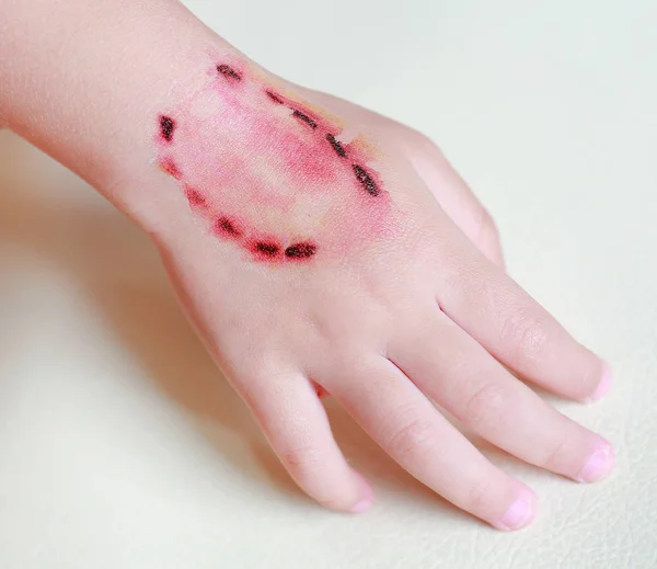 Ferimento de adesivo e sangue de uma mordida dentes humanos na mão da criança, Vestir-se tatuagens, Conceito de Halloween . — Fotografia de Stock