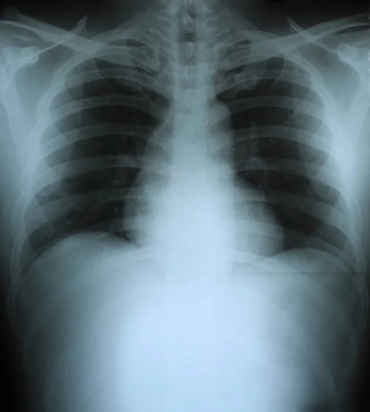 Xray en mänskliga bröstkorgen (bröstet). — Stockfoto