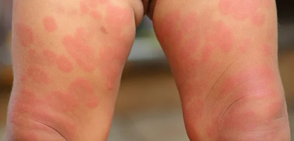 Babyausschläge am Bein, Dermatitis — Stockfoto