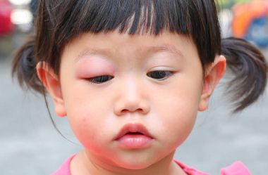 Asya bebek kız göz harika, sonra gözüne ısırma sivrisinek Anti