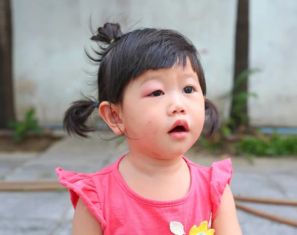 Azjatki baby girl oczu puchnąć, alergii po komary gryzący w oczy — Zdjęcie stockowe