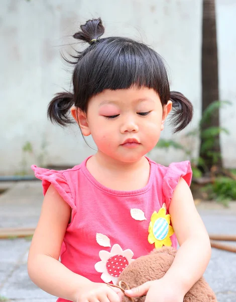 Азиатская девочка глаза опухают, аллергия на комаров укуса в глаз — стоковое фото