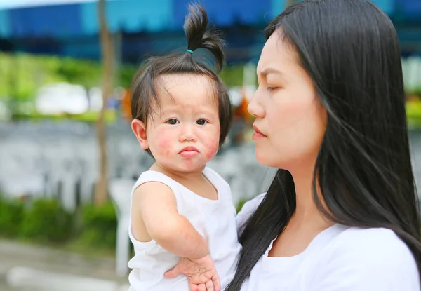 Bayi dengan ruam dalam pelukan ibu — Stok Foto