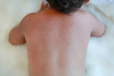 Close up baby back dry skin. Baby have very dry peeling skin. clipart