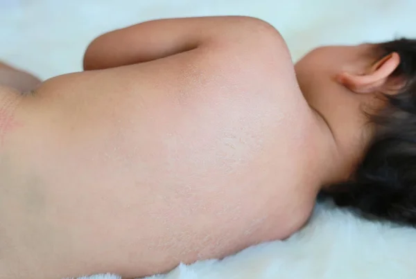 Hautnah Baby Zurück Trockene Haut Babys Haben Sehr Trockene Haut — Stockfoto