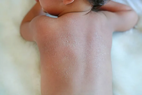 Cerrar Piel Seca Espalda Del Bebé Bebé Tiene Piel Muy — Foto de Stock