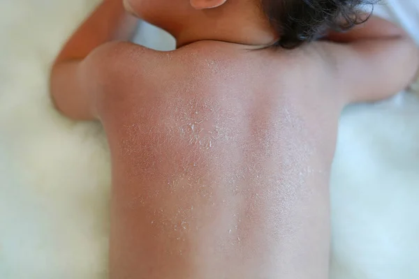 Fermer Bebe Dos Peau Seche Bebe Ont Une Peau Pelante Tres Seche Patient Beaute Stock Photo