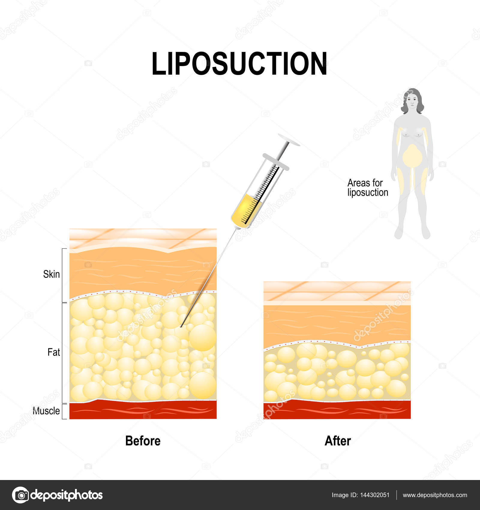 Liposuction process and areas for lipo. Stock Vector Image by