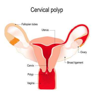 cervical polyp on the uterus clipart