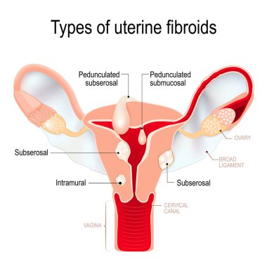 uterin fibroids türleri: subserosal, intramural, submucosal, bir
