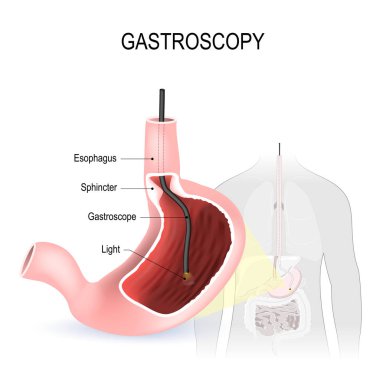 Gastroskopi, bekarlar ve duodenoscopy