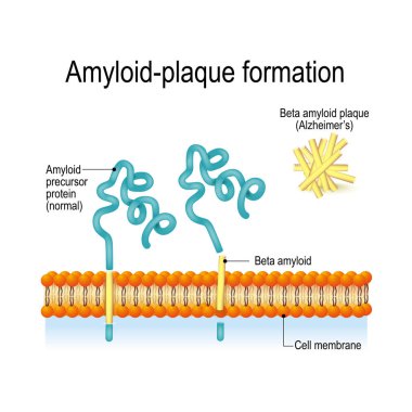 Amiloid plak oluşumu. Alzheimer hastalığı