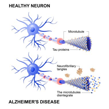 sağlıklı hücre ve neurons Alzheimer hastalığı ile. Tau hypothesi