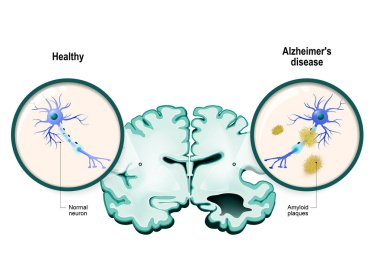 Alzheimer's disease. Neurons and brain clipart