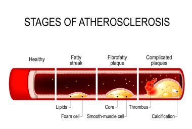 stages of atherosclerosis clipart
