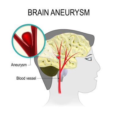 Blood vessels in the brain with aneurysm clipart