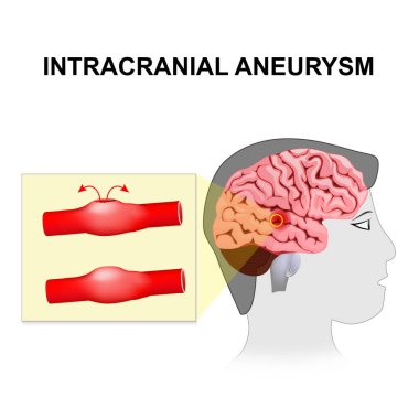 Intracranial aneurysm. cerebral or brain aneurysm. clipart