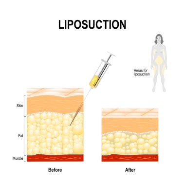 Liposuction işlemi ve alanlar Liposuction için. 