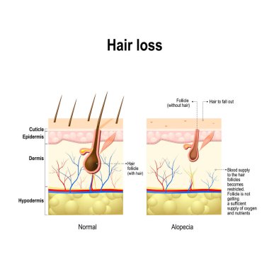 Hair loss. Normal hair and Alopecia areata in the human skin. alopecia or baldness.  clipart