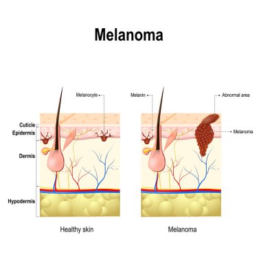 Melanoma or skin cancer.  clipart