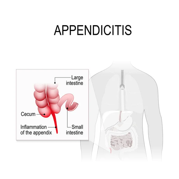 Apendicitis. Ubicación en el sistema digestivo humano — Vector de stock