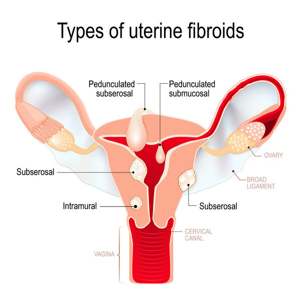 types of uterine fibroids: subserosal, intramural, submucosal, a