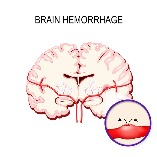 Emorragia cerebrale. Ictus e sanguinamento nel cervello umano . — Vettoriale Stock