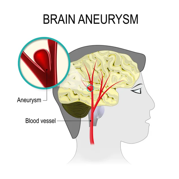 Blood vessels in the brain with aneurysm — Stock Vector