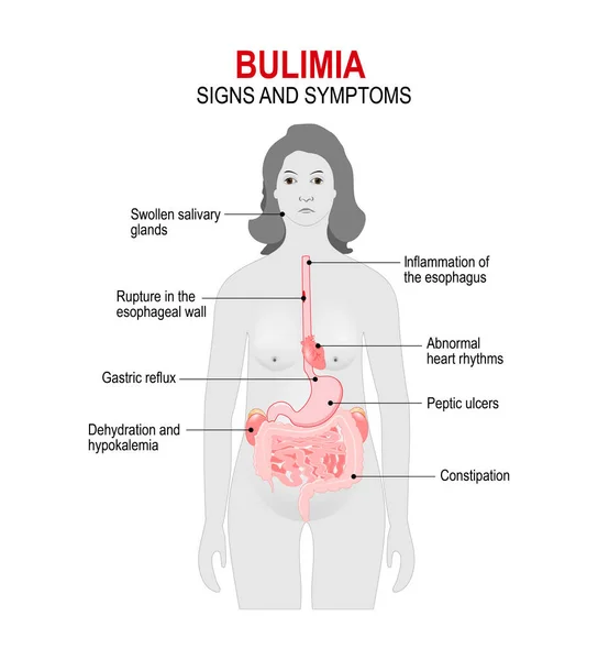 Bulimie ist eine Essstörung. — Stockvektor
