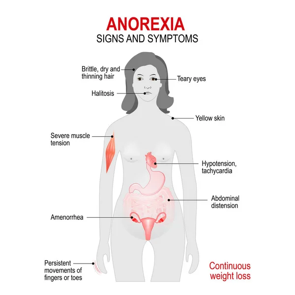 Anorexia nervosa is een eetstoornis — Stockvector