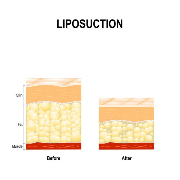 Lipoaspiração é um tipo de cirurgia estética para remover a gordura do corpo humano . — Vetor de Stock