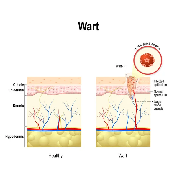 O Wart. Secção transversal da pele humana com infeção pelo papilomavírus humano . —  Vetores de Stock