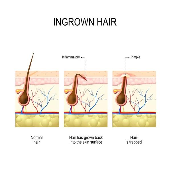 Epilasyon ve tıraş sonra batık saç — Stok Vektör