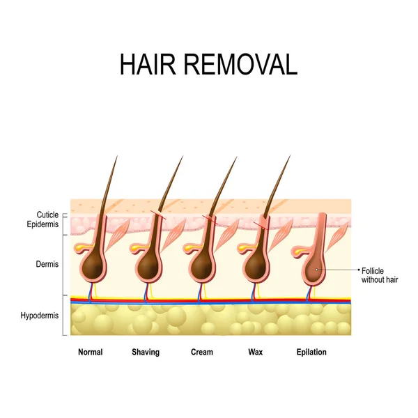 Remoção de cabelo com cera, creme, depilação e barbear . — Vetor de Stock