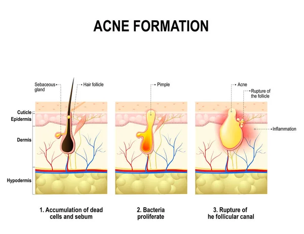 Três estágios da formação de acne na pele humana . —  Vetores de Stock