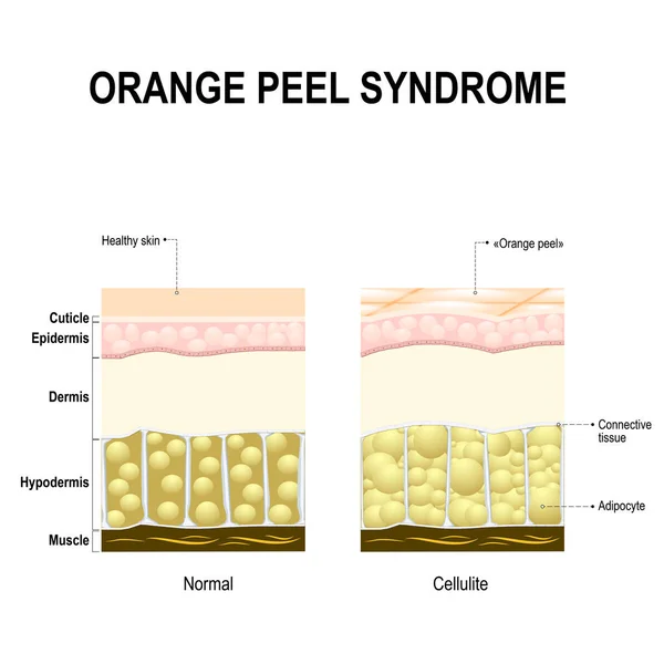 Cellulite nota anche come sindrome della buccia d'arancia . — Vettoriale Stock