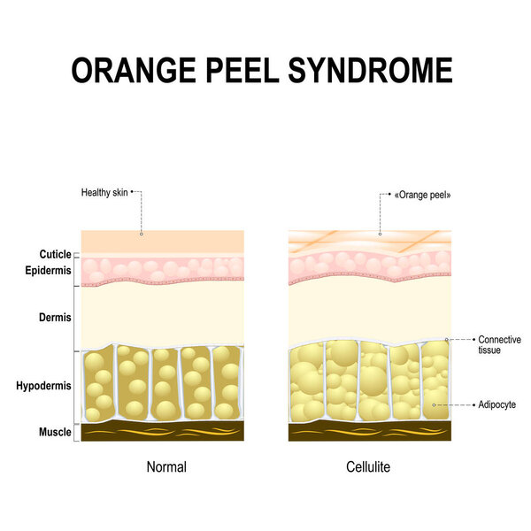 Cellulite also known as orange peel syndrome.