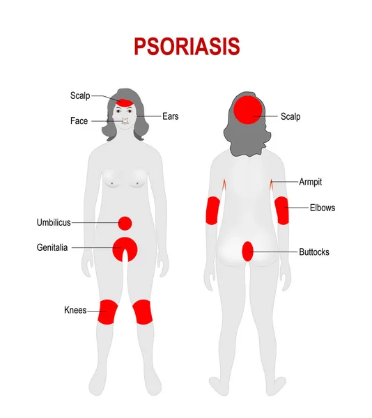 Psoriasis. Gebieden van het lichaam meestal beïnvloed. — Stockvector