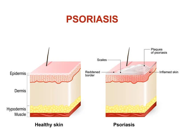 Síntomas de la psoriasis . — Vector de stock