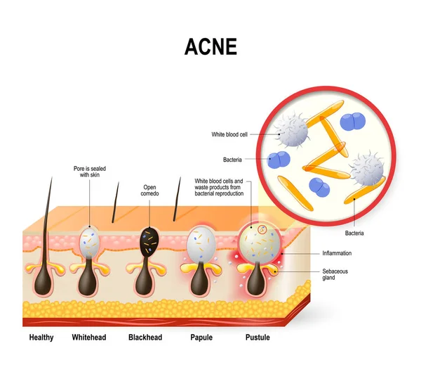 Acne vulgaris o brufolo . — Vettoriale Stock