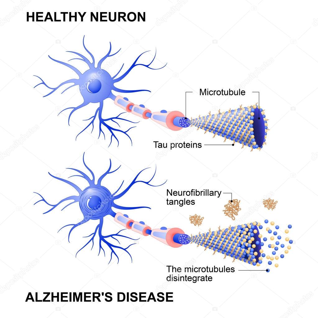 healthy cell and neurons with Alzheimer's disease. Tau hypothesi