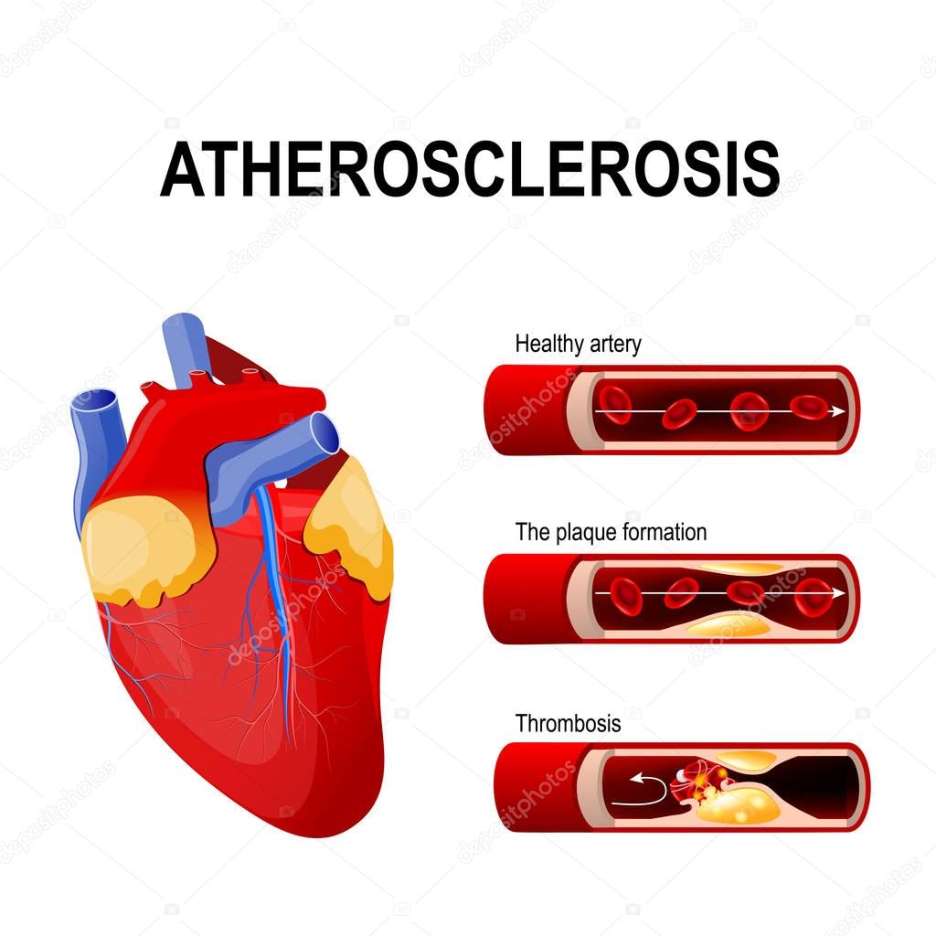 Atherosclerosis stages: Healthy artery, the plaque formation and thrombosis. A