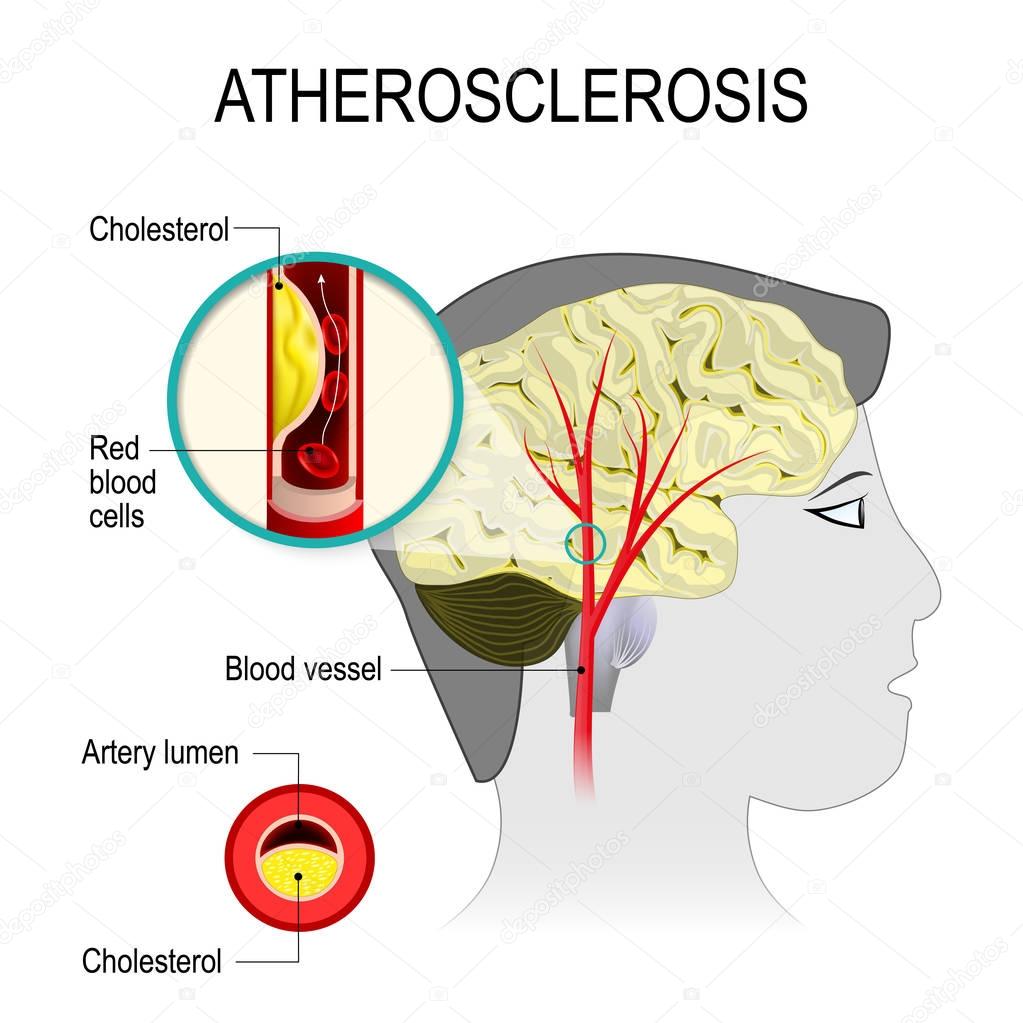 Cerebral artery with atherosclerosis
