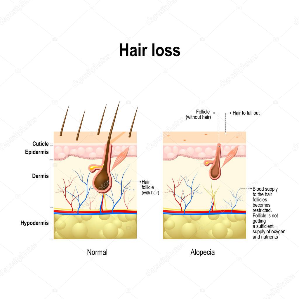 Hair loss. Normal hair and Alopecia areata in the human skin. alopecia or baldness. 