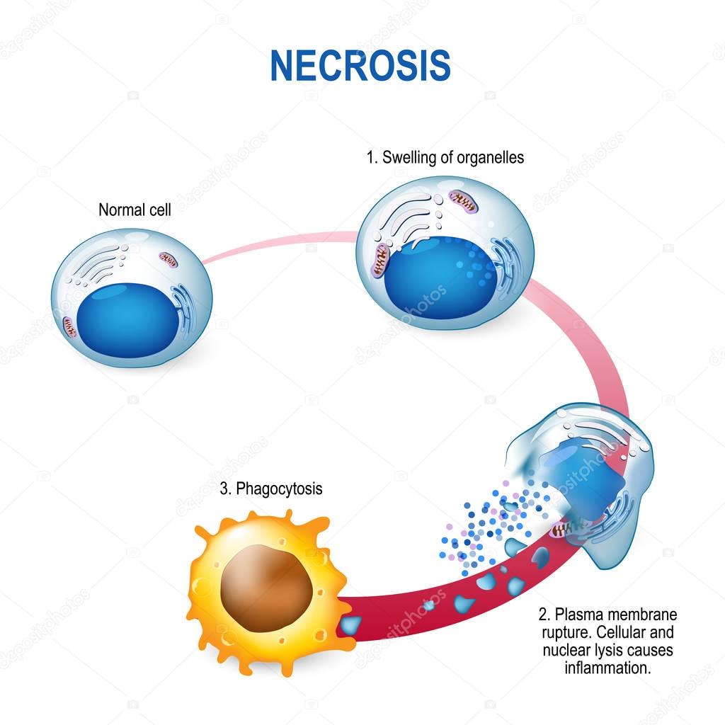 necrosis - Pathologic Cell Death.