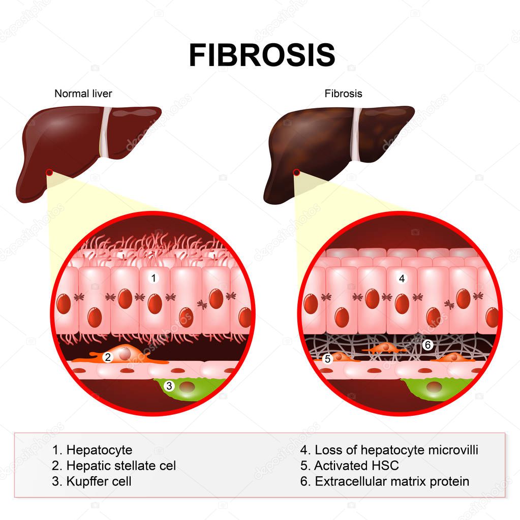 liver fibrosis. Cirrhosis