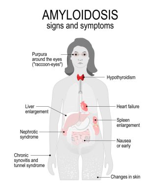 Amyloidosis. Signs and symptoms. clipart