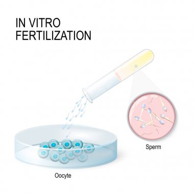 In vitro fertilization. artificial insemination clipart